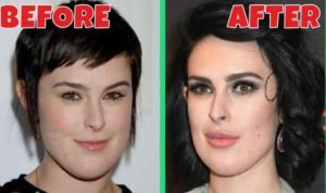 Rumer Willis plastic surgery before after